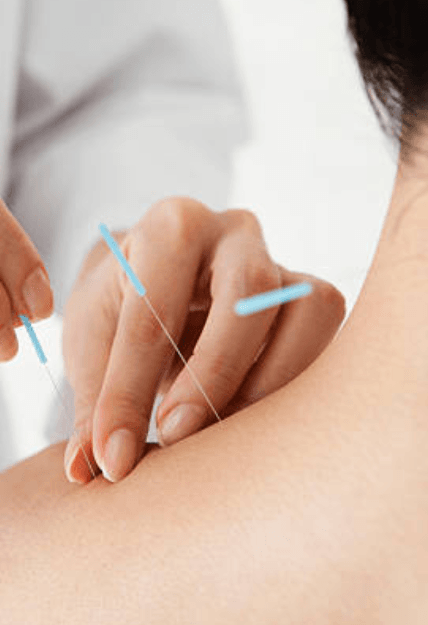 acupuntura_cervicales